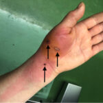 Hand with infected cat bite wounds showing redness and swelling