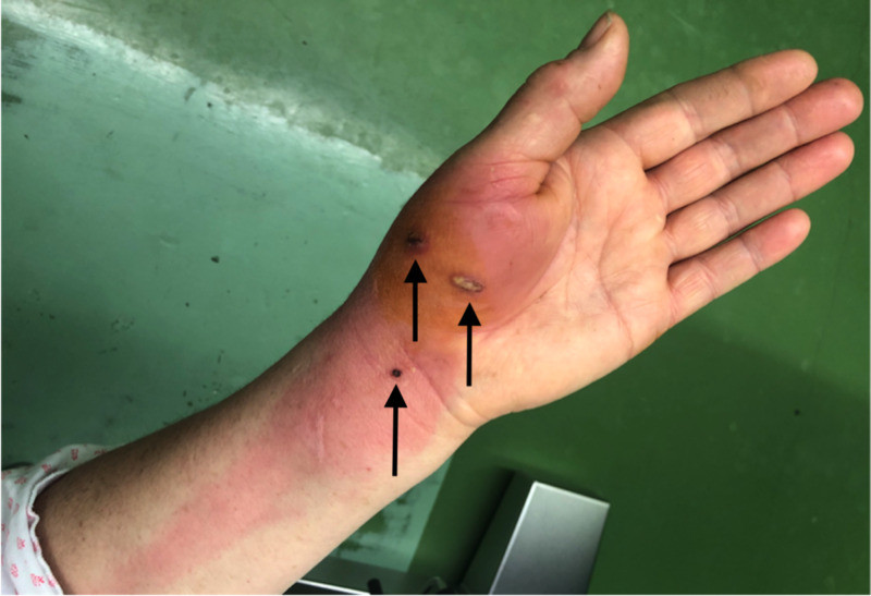 Hand with infected cat bite wounds showing redness, swelling, and lymphangitis