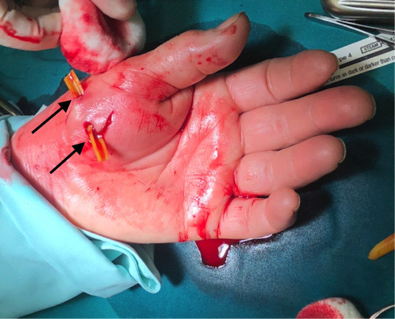 Surgical debridement and irrigation of infected cat bite wounds